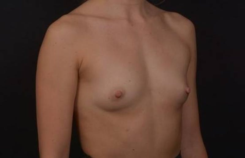 Breast Augmentation Silicone Gel Before & After Gallery - Patient 285636 - Image 7