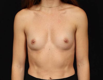 Breast Augmentation Silicone Gel Before & After Gallery - Patient 429428 - Image 1