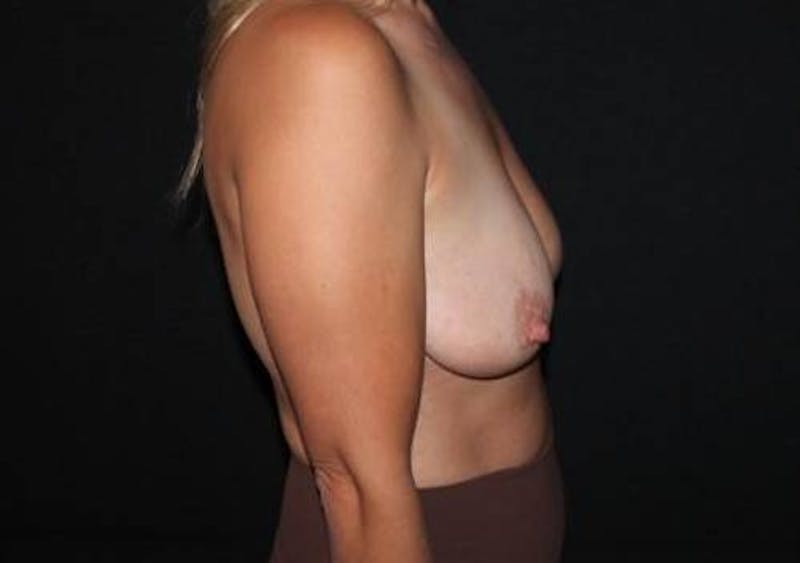 Breast Augmentation Mastopexy Before & After Gallery - Patient 173898 - Image 9
