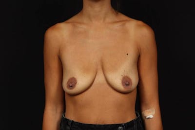 Breast Augmentation Mastopexy Before & After Gallery - Patient 493304 - Image 1