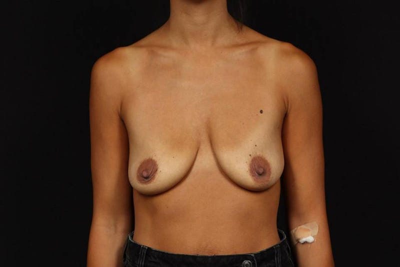 Breast Augmentation Mastopexy Before & After Gallery - Patient 493304 - Image 1