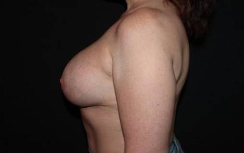 Aesthetic Breast Revision Before & After Gallery - Patient 190612 - Image 6