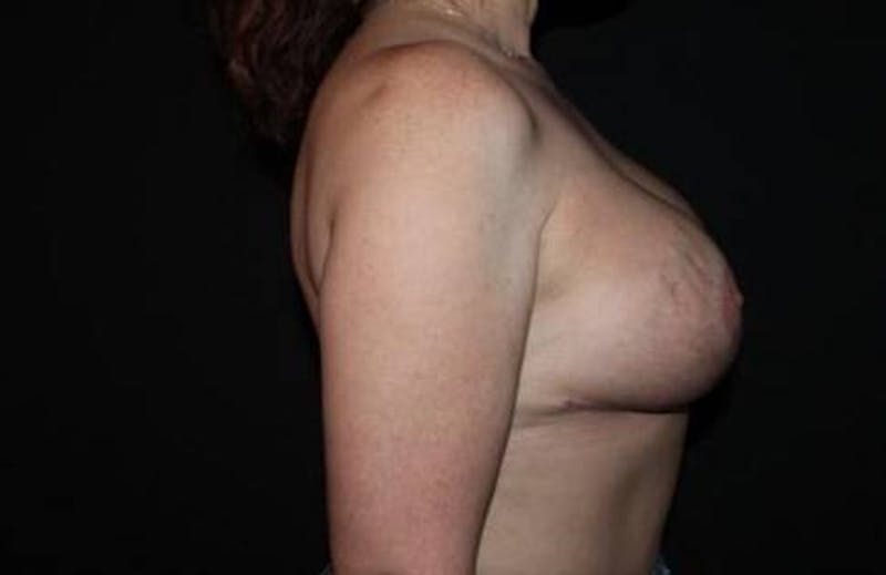 Aesthetic Breast Revision Before & After Gallery - Patient 190612 - Image 10