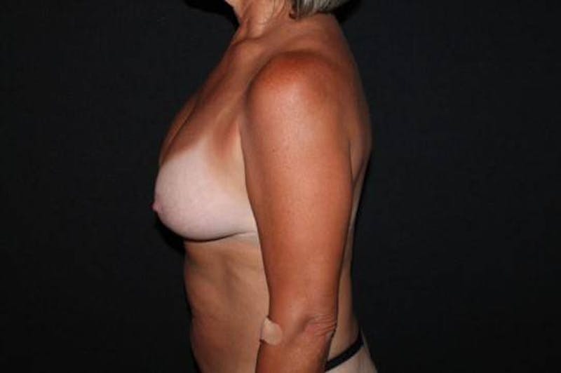 Breast Implant Removal and Mastopexy Before & After Gallery - Patient 424526 - Image 5