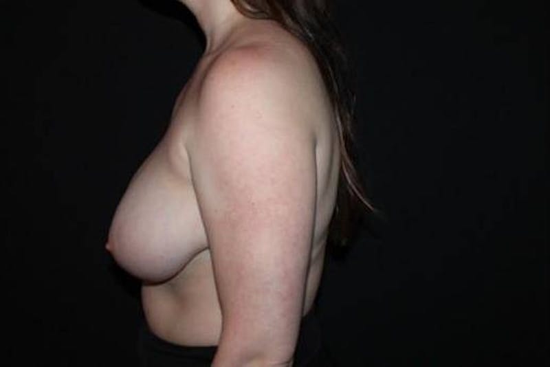 Breast Reduction Before & After Gallery - Patient 284685 - Image 5