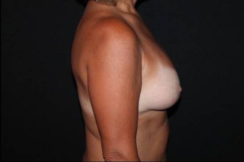 Breast Implant Removal and Mastopexy Before & After Gallery - Patient 424526 - Image 9