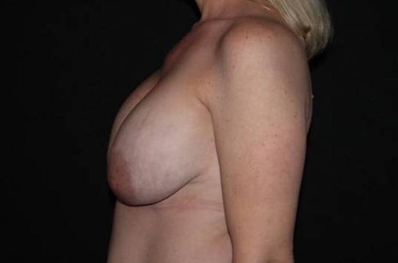 Breast Implant Removal and Mastopexy Before & After Gallery - Patient 946427 - Image 5