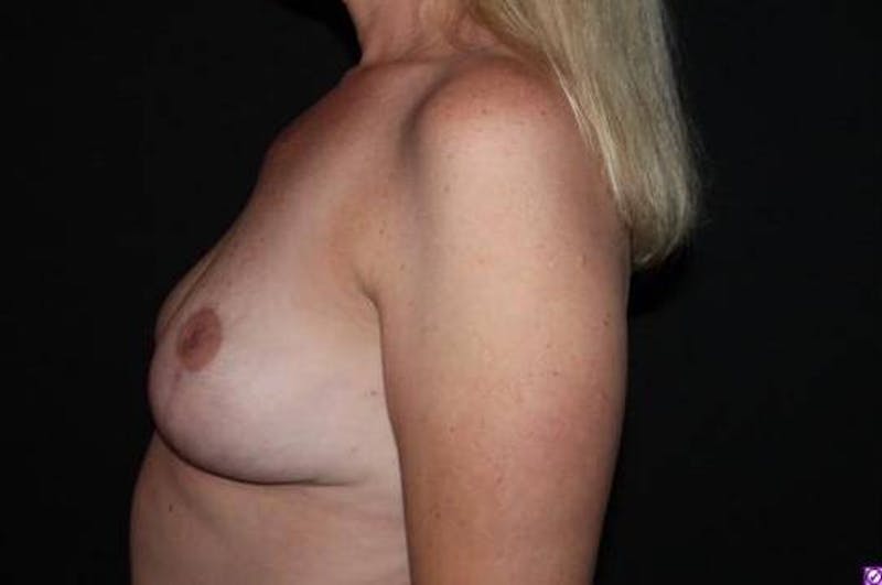 Breast Implant Removal and Mastopexy Before & After Gallery - Patient 946427 - Image 6