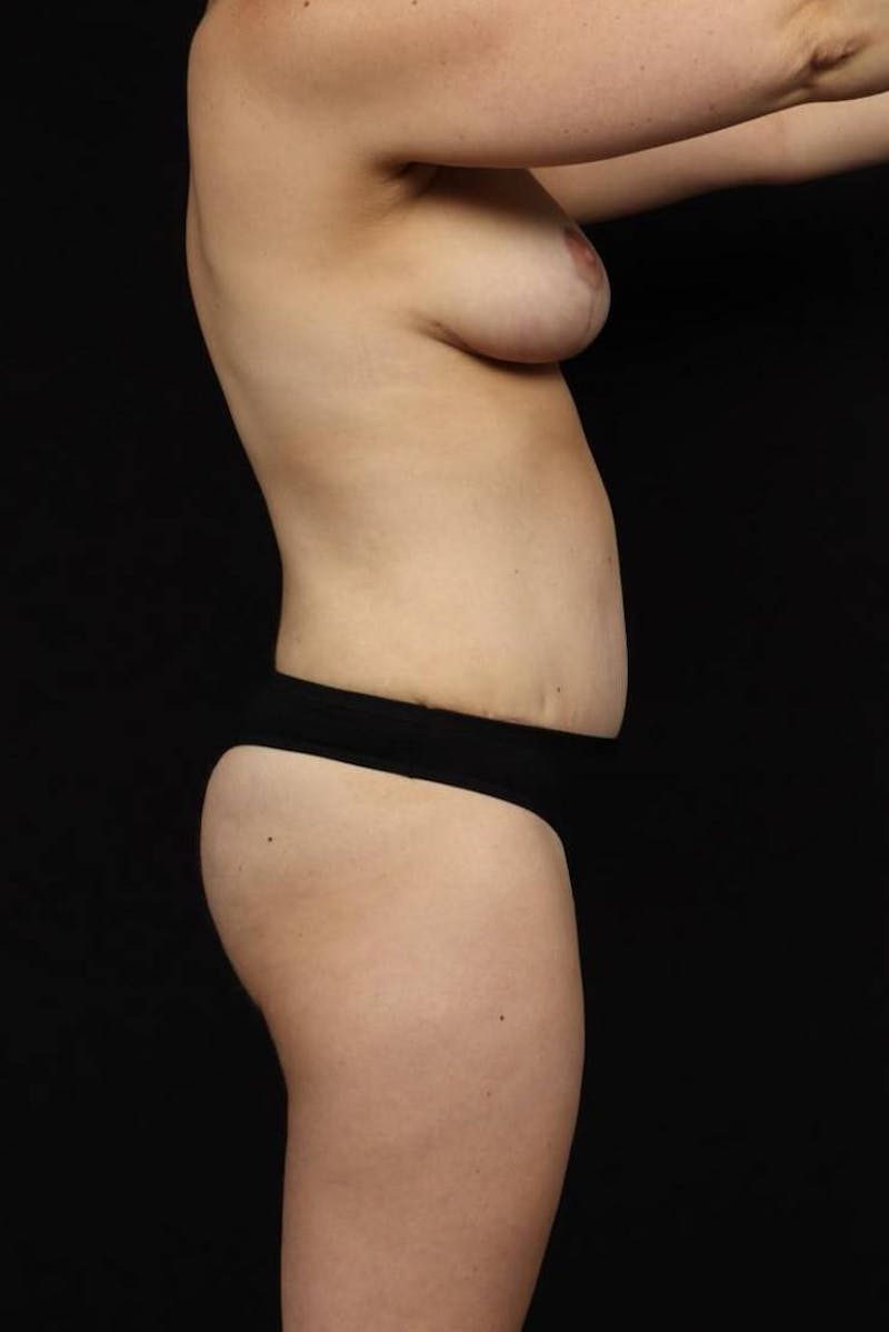 Breast Reduction Before & After Gallery - Patient 131811 - Image 10