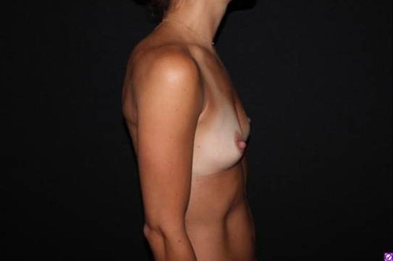Breast Augmentation Silicone Gel Before & After Gallery - Patient 318730 - Image 9