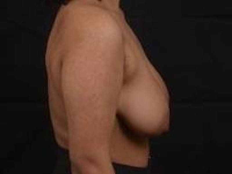 Breast Reduction Before & After Gallery - Patient 364401 - Image 5
