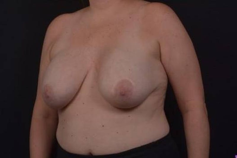 Aesthetic Breast Revision Before & After Gallery - Patient 162126 - Image 3