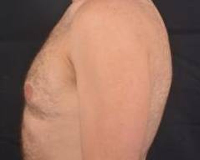 Gynecomastia Before & After Gallery - Patient 148368 - Image 3