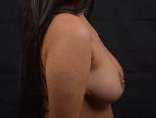 Breast Reduction Before & After Gallery - Patient 364401 - Image 6