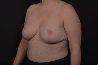 Aesthetic Breast Revision Before & After Gallery - Patient 162126 - Image 4