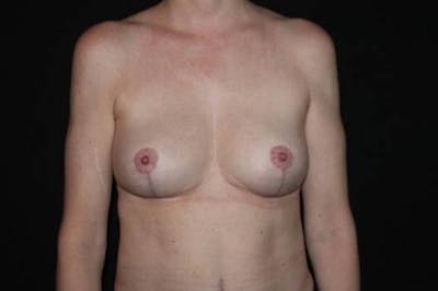 Breast Implant Removal and Mastopexy Before & After Gallery - Patient 263376 - Image 2