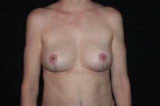 Breast Implant Removal and Mastopexy Before & After Gallery - Patient 263376 - Image 2
