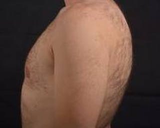 Gynecomastia Before & After Gallery - Patient 148368 - Image 4