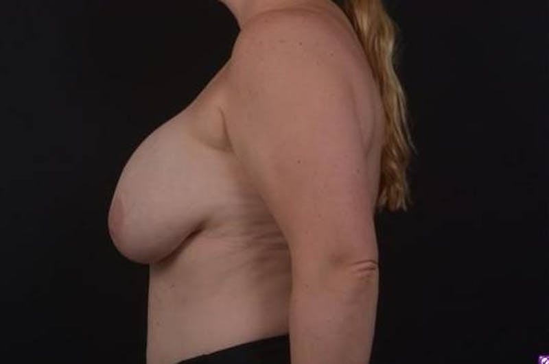 Aesthetic Breast Revision Before & After Gallery - Patient 162126 - Image 5