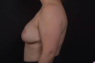 Aesthetic Breast Revision Before & After Gallery - Patient 162126 - Image 6