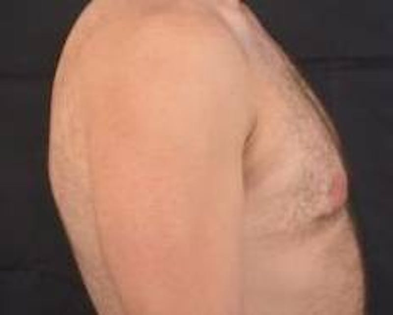 Gynecomastia Before & After Gallery - Patient 148368 - Image 5
