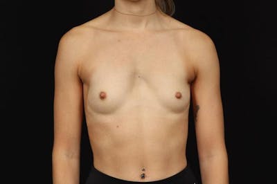 Breast Augmentation Silicone Gel Before & After Gallery - Patient 369762 - Image 1