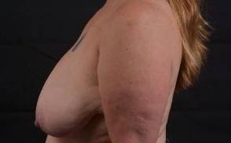 Breast Reduction Before & After Gallery - Patient 171362 - Image 3