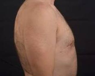 Gynecomastia Before & After Gallery - Patient 148368 - Image 6
