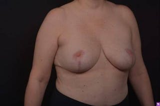 Aesthetic Breast Revision Before & After Gallery - Patient 162126 - Image 8