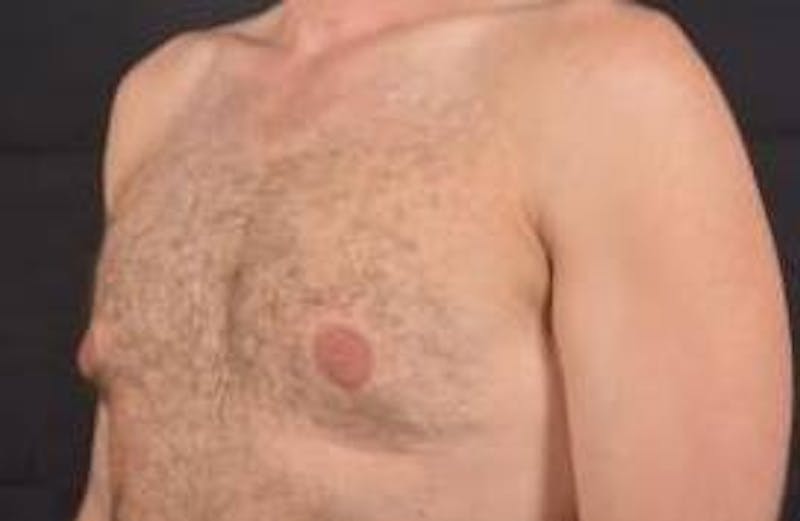 Gynecomastia Before & After Gallery - Patient 148368 - Image 7