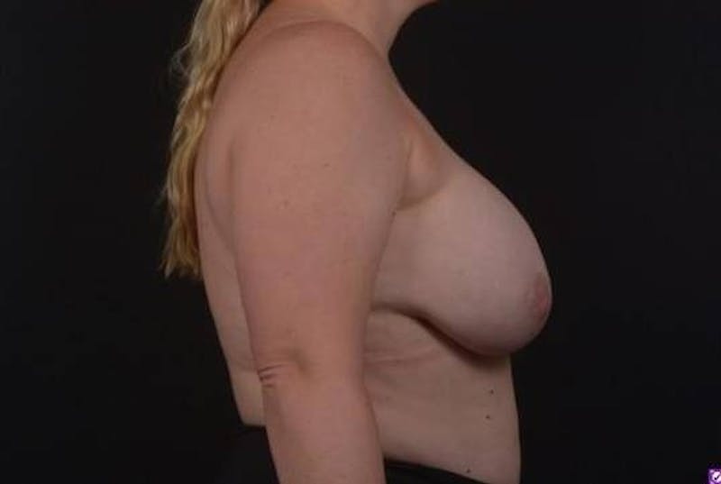 Aesthetic Breast Revision Before & After Gallery - Patient 162126 - Image 9