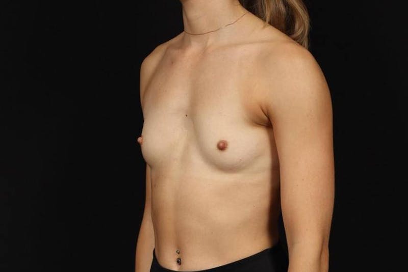 Breast Augmentation Silicone Gel Before & After Gallery - Patient 369762 - Image 3