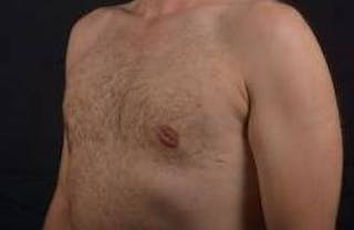 Gynecomastia Before & After Gallery - Patient 148368 - Image 8