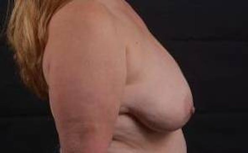 Breast Reduction Before & After Gallery - Patient 171362 - Image 5