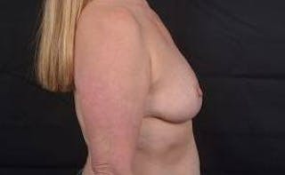Breast Reduction Before & After Gallery - Patient 171362 - Image 6