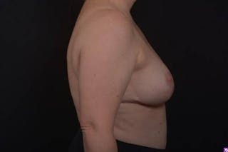 Aesthetic Breast Revision Before & After Gallery - Patient 162126 - Image 10