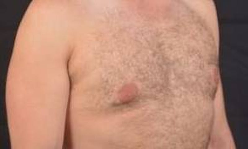 Gynecomastia Before & After Gallery - Patient 148368 - Image 9