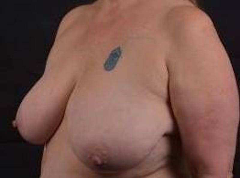 Breast Reduction Before & After Gallery - Patient 171362 - Image 7