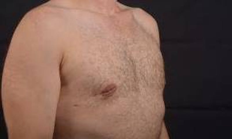 Gynecomastia Before & After Gallery - Patient 148368 - Image 10