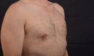 Gynecomastia Before & After Gallery - Patient 148368 - Image 10