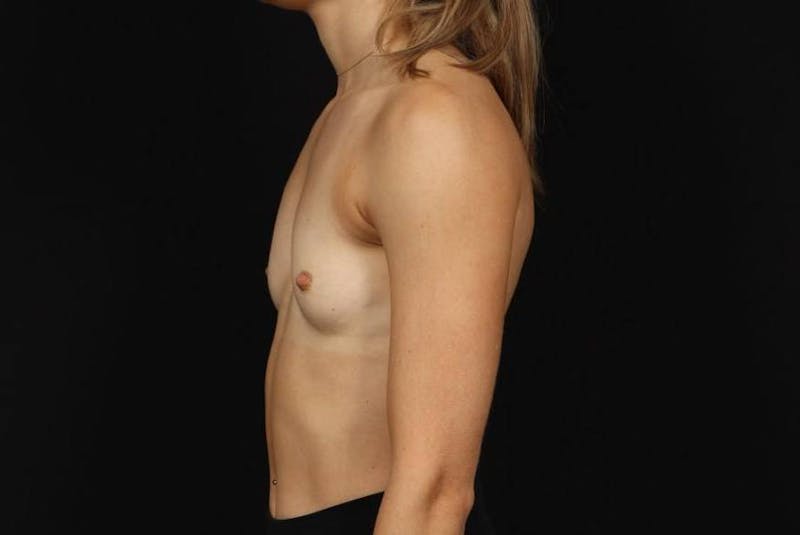 Breast Augmentation Silicone Gel Before & After Gallery - Patient 369762 - Image 5