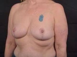 Breast Reduction Before & After Gallery - Patient 171362 - Image 8