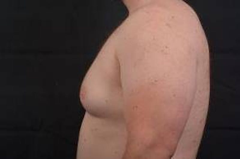 Gynecomastia Before & After Gallery - Patient 153510 - Image 3