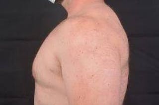Gynecomastia Before & After Gallery - Patient 153510 - Image 4