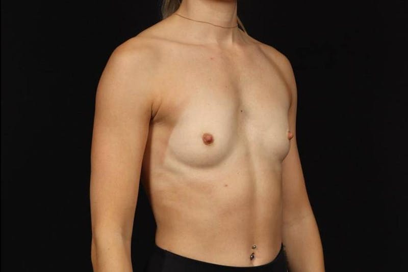Breast Augmentation Silicone Gel Before & After Gallery - Patient 369762 - Image 7