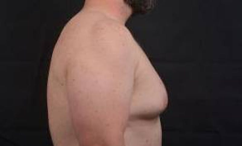 Gynecomastia Before & After Gallery - Patient 153510 - Image 5