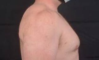 Gynecomastia Before & After Gallery - Patient 153510 - Image 6