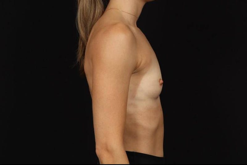 Breast Augmentation Silicone Gel Before & After Gallery - Patient 369762 - Image 9