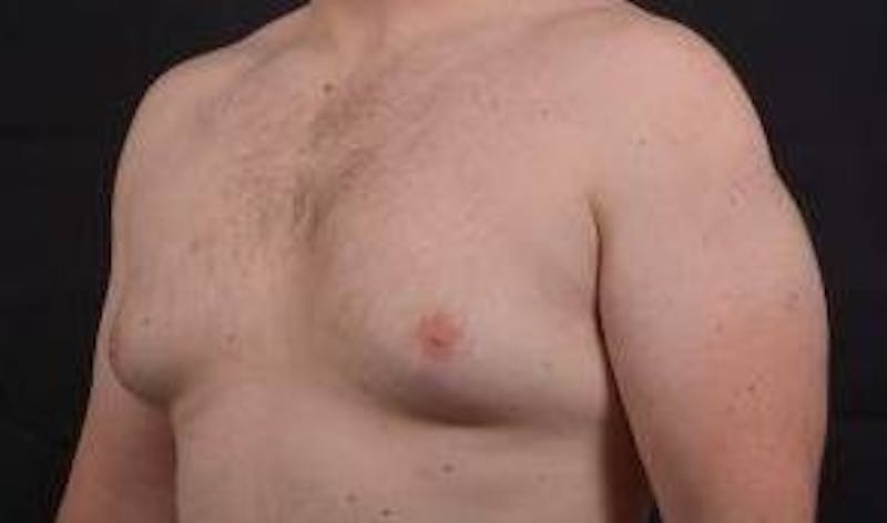 Gynecomastia Before & After Gallery - Patient 153510 - Image 7