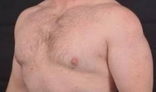 Gynecomastia Before & After Gallery - Patient 153510 - Image 8